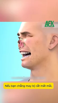 Bị cắt mất mũi phải làm sao?